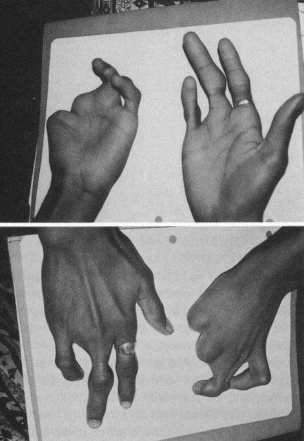 misvormingen vingers